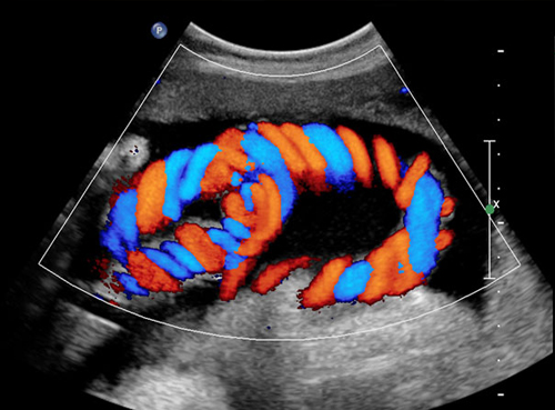 Color Doppler